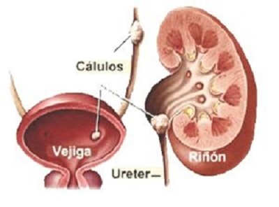 Litiasis renal causas
